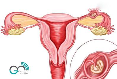 تشخیص بارداری خارج رحمی با سونوگرافی