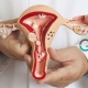 کیست تخمدان و تشخیص با سونوگرافی