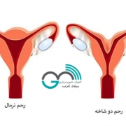 تشخیص رحم دوقطبی یا دوشاخ /سونوگرافی بارداری