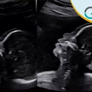 سونوگرافی غربالگری سندروم داون /سونوگرافی در غرب تهران